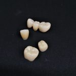 保険治療でも白い歯を：Part2(詰め物）